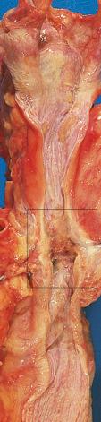 Figure 16-131, Carcinoma of the esophagus.