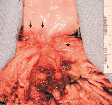 Figure 16-132, Barrett esophagus with adenocarcinoma.