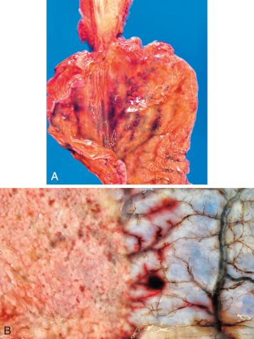 Figure 16-133, Postmortem loss of gastric mucosa.