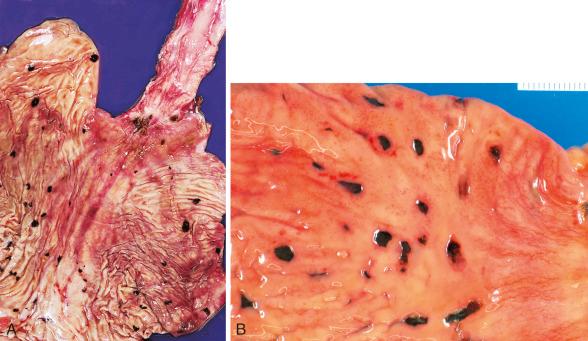 Figure 16-134, Gastric stress ulcers.