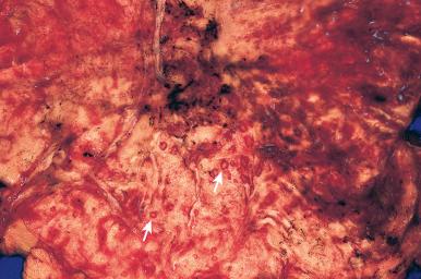 Figure 16-135, Gastric candidiasis.