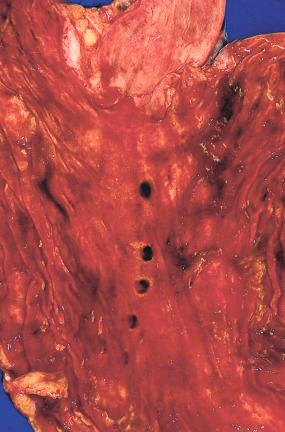 Figure 16-136, Iatrogenic gastric ulceration.