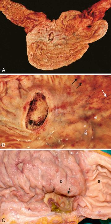 Figure 16-137, Peptic ulcers.