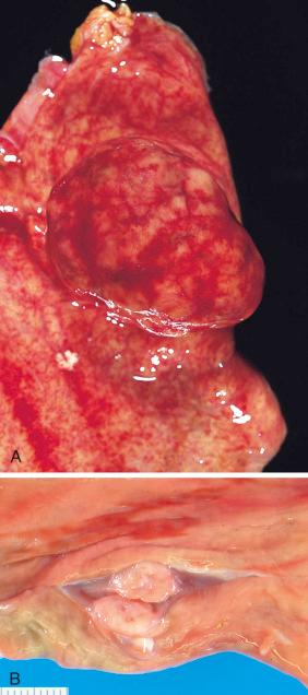 Figure 16-139, Gastric mesenchymal tumors.