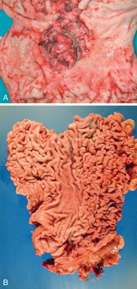 Figure 16-140, Gastric carcinoma.