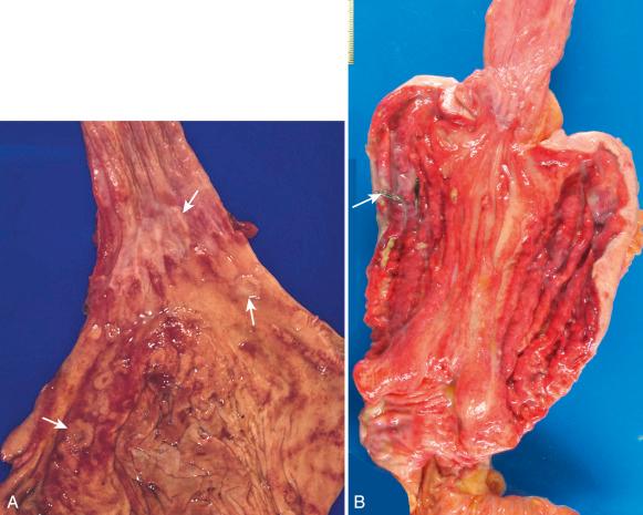 Figure 16-141, Upper gastrointestinal lymphoma.