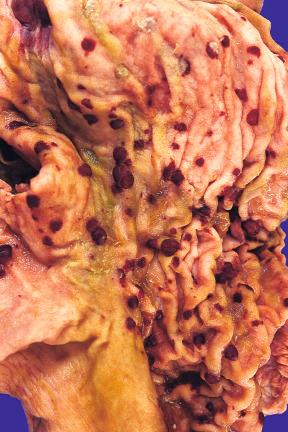 Figure 16-142, Kaposi sarcoma.