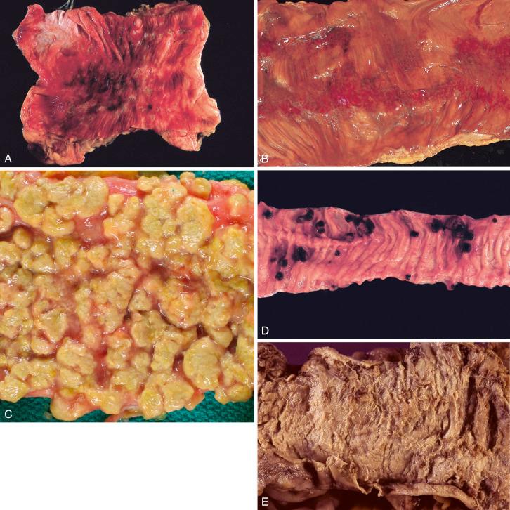 Figure 16-146, Enterocolitis.