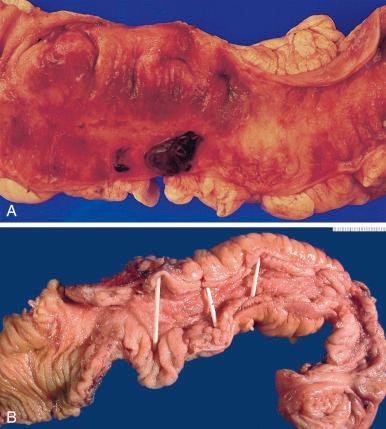 Figure 16-148, Crohn disease.