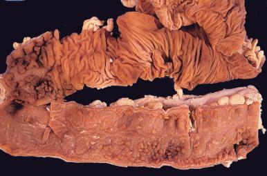 Figure 16-149, Ulcerative colitis.