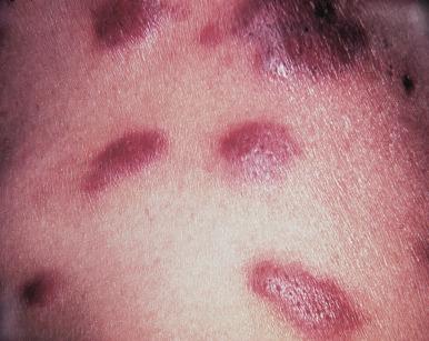 Figure 16-15, Kaposi sarcoma.