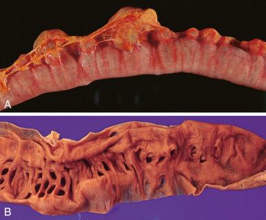 Figure 16-152, Acquired diverticular disease of the intestines.