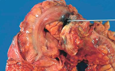 Figure 16-153, Diverticulitis.