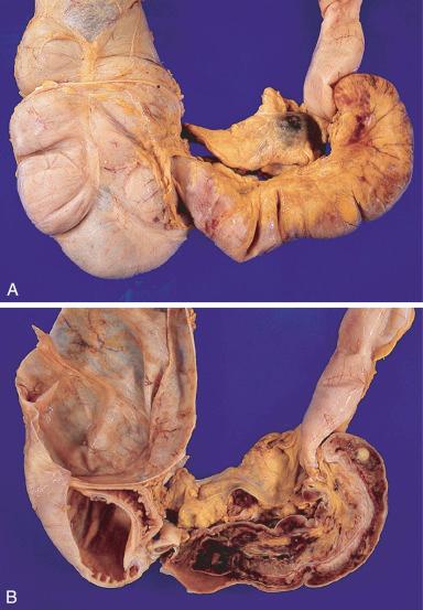 Figure 16-154, Intussusception.