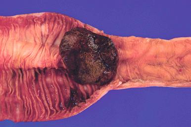Figure 16-156, Tumor metastatic to small intestine.