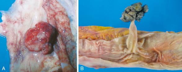 Figure 16-157, Colonic polyps.