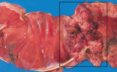 Figure 16-158, Carcinoma of the colon.