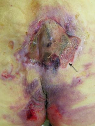 Figure 16-19, Sacral decubitus ulcer.