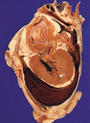 Figure 16-22, Hemopericardium.