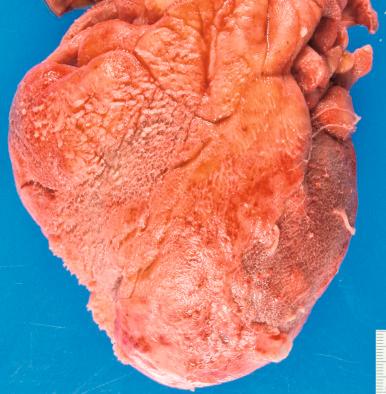 Figure 16-23, Fibrinous pericarditis.