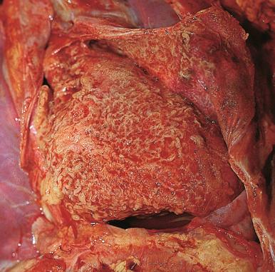 Figure 16-24, Suppurative pericarditis.