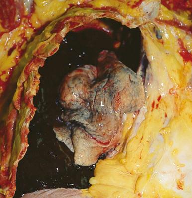 Figure 16-25, Hemothorax.