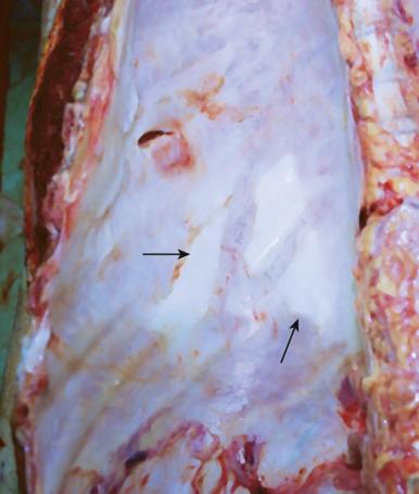 Figure 16-28, Pleural plaques.