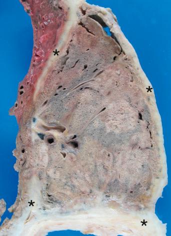 Figure 16-29, Malignant mesothelioma.