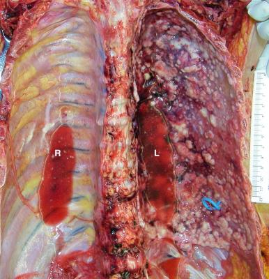 Figure 16-30, Metastatic carcinoma involving the pleura.