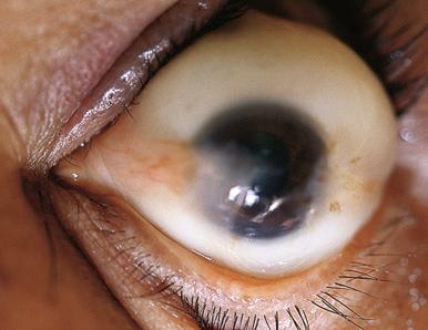 Figure 16-3, Conjunctival pterygia.