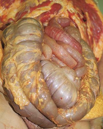 Figure 16-31, Dilation of the small and large intestines.