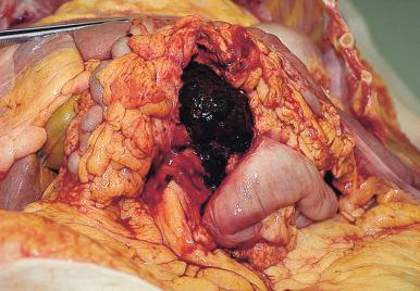 Figure 16-32, Hemoperitoneum.