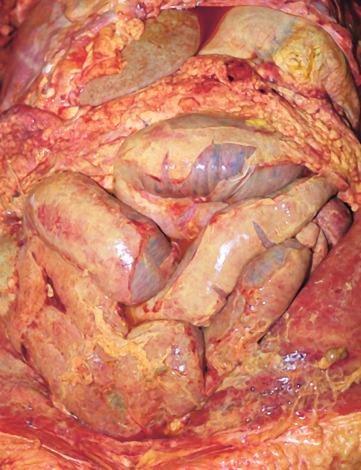 Figure 16-33, Bacterial peritonitis.