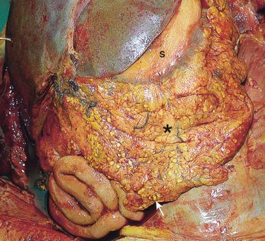 Figure 16-35, Omentum with fat necrosis.