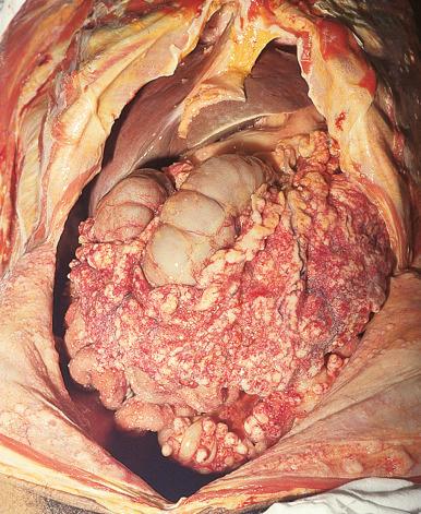 Figure 16-36, Tuberculous peritonitis.