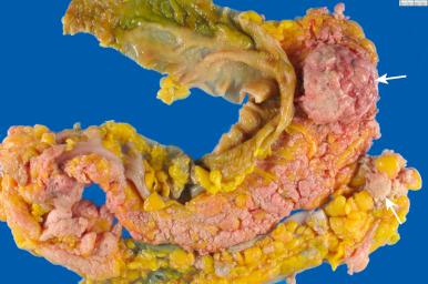 Figure 16-37, Carcinoma metastatic to peritoneum.