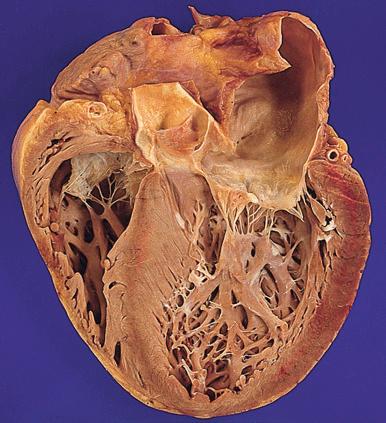 Figure 16-38, Dilated cardiomyopathy.