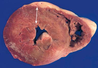 Figure 16-39, Left ventricular hypertrophy.