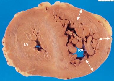 Figure 16-40, Right ventricular hypertrophy.
