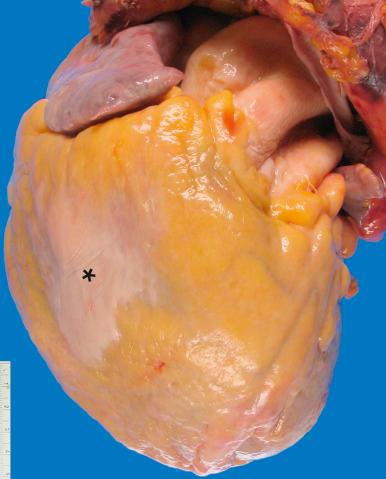 Figure 16-41, Epicardial fibrous plaques.