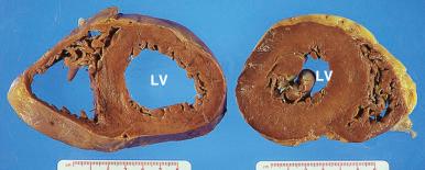 Figure 16-42, Eccentric and concentric hypertrophy.