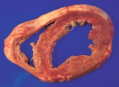 Figure 16-43, Dilated cardiomyopathy.