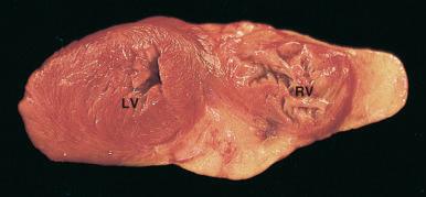 Figure 16-44, Right ventricular dilation.