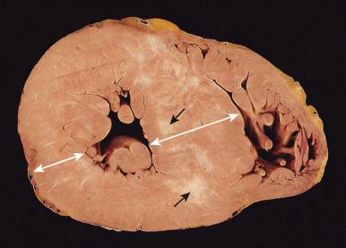 Figure 16-45, Hypertrophic cardiomyopathy.