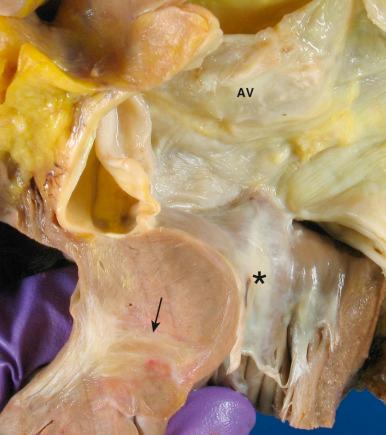 Figure 16-46, Subaortic stenosis.