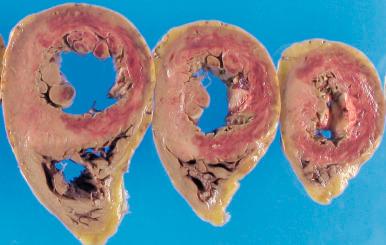 Figure 16-49, Acute transmural myocardial infarct.