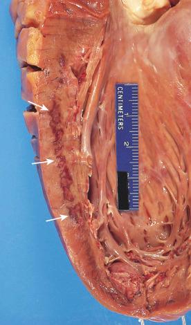 Figure 16-50, Acute subendocardial myocardial infarct.