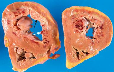 Figure 16-51, Acute and healed myocardial infarcts.