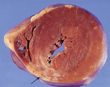 Figure 16-52, Healed posteroseptal myocardial infarct.