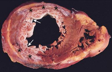 Figure 16-53, Healed transmural and subendocardial myocardial infarcts.